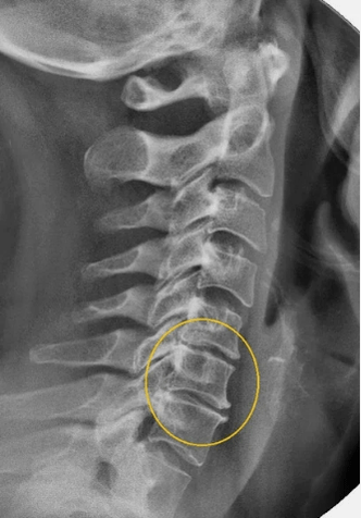 Bizkarrezurreko bizkarrezurraren osteokondrosia x -Ray batean